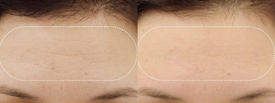 EMFACE™: Patient 6 - Before and After  