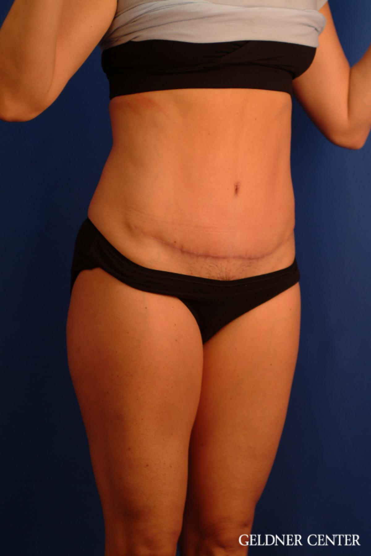 Tummy Tuck: Patient 34 - After 2