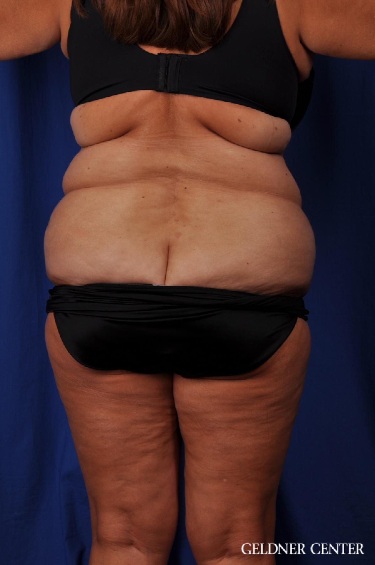Tummy Tuck: Patient 20 - Before 3
