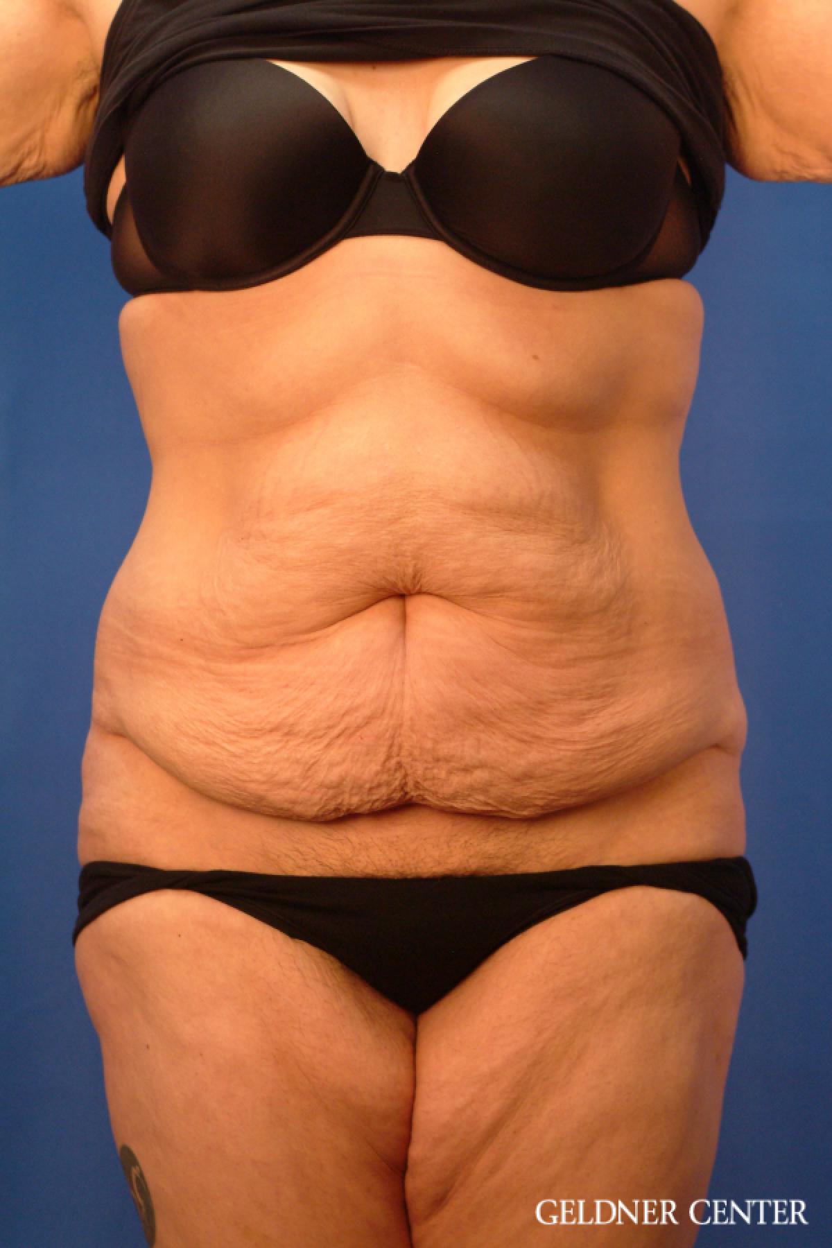 Tummy Tuck: Patient 19 - Before 