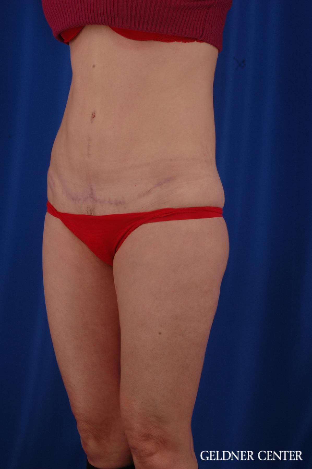 Tummy Tuck: Patient 36 - After 4
