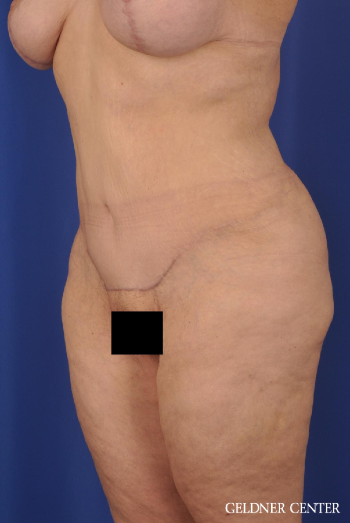 Tummy Tuck: Patient 19 - After 4