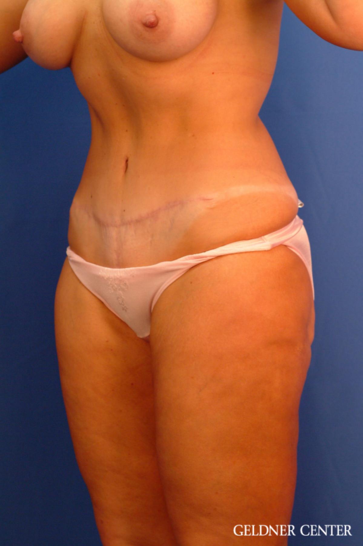 Tummy Tuck: Patient 17 - After 4