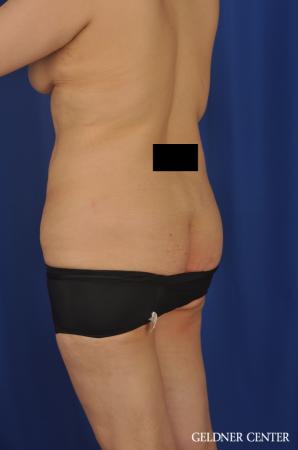 Lipoabdominoplasty: Patient 7 - Before and After Image 5