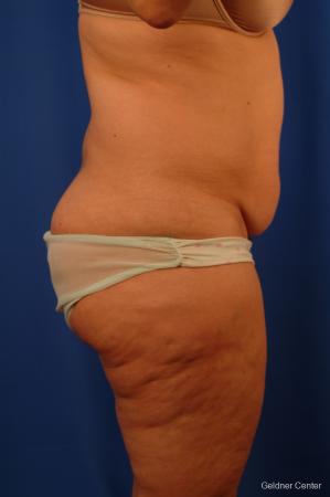 Lipoabdominoplasty: Patient 3 - Before Image 2