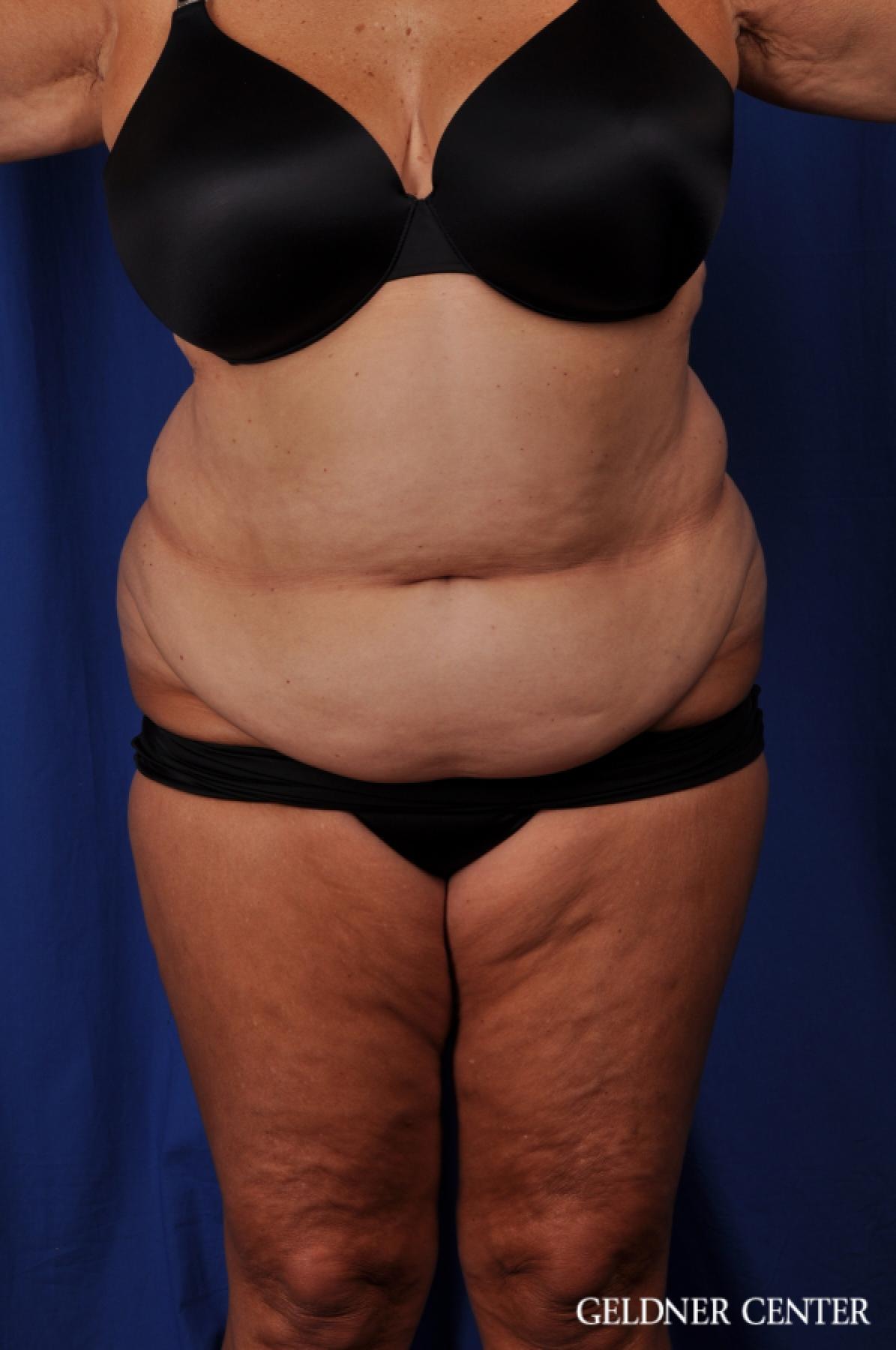 Tummy Tuck: Patient 20 - Before 