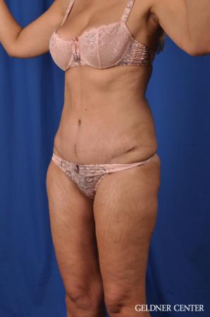 Lipoabdominoplasty: Patient 5 - After Image 4