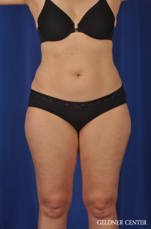 Liposuction: Patient 32 - Before 1