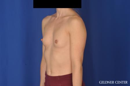 Breast Augmentation: Patient 187 - Before and After 4