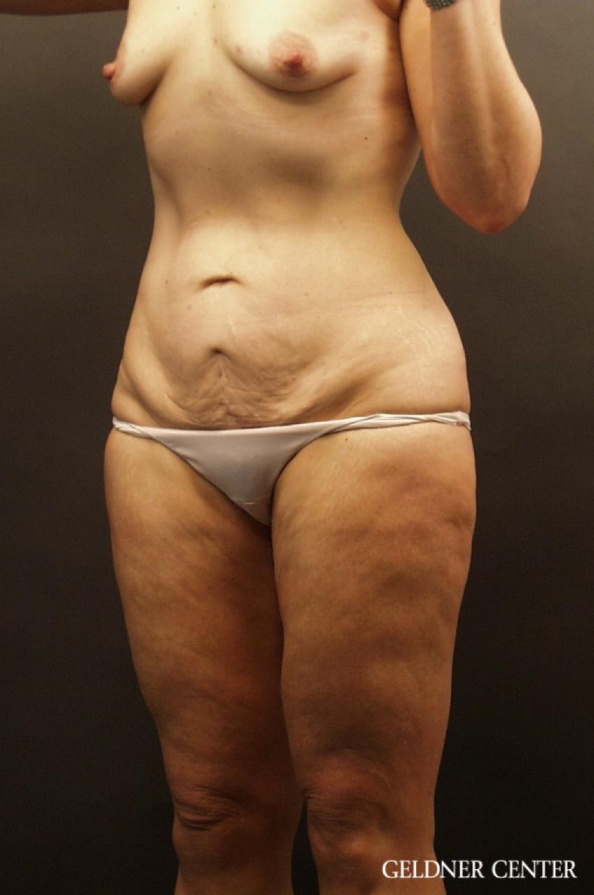 Tummy Tuck: Patient 17 - Before and After 4