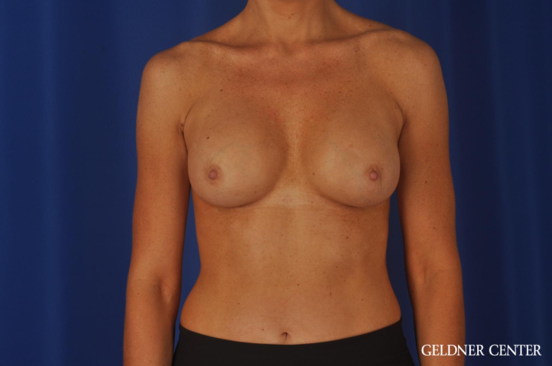Chicago Breast Augmentation 8745 -  After 1