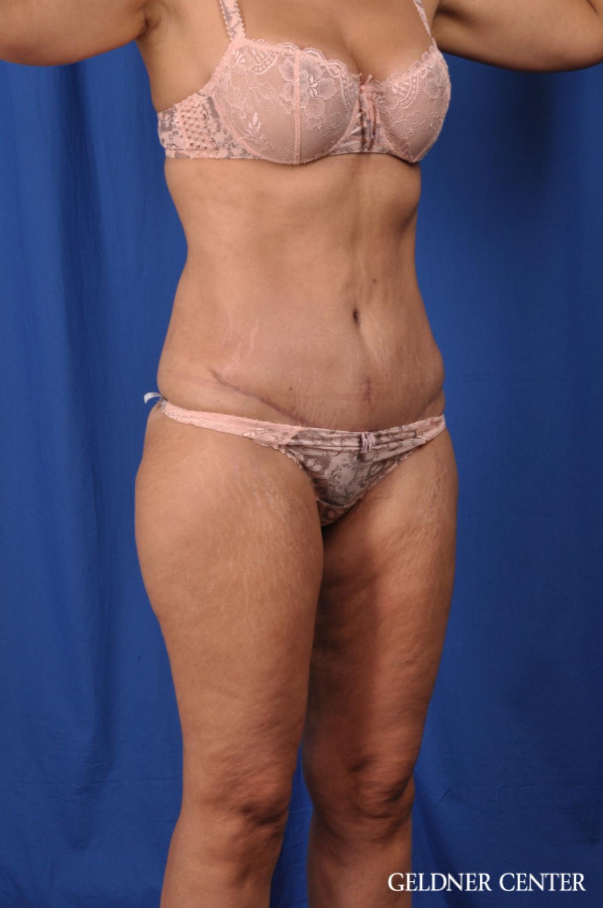 Tummy Tuck: Patient 21 - After 2