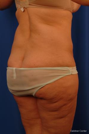 Lipoabdominoplasty: Patient 3 - Before Image 3