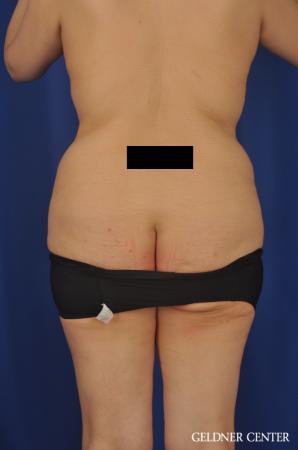 Lipoabdominoplasty: Patient 7 - Before Image 4