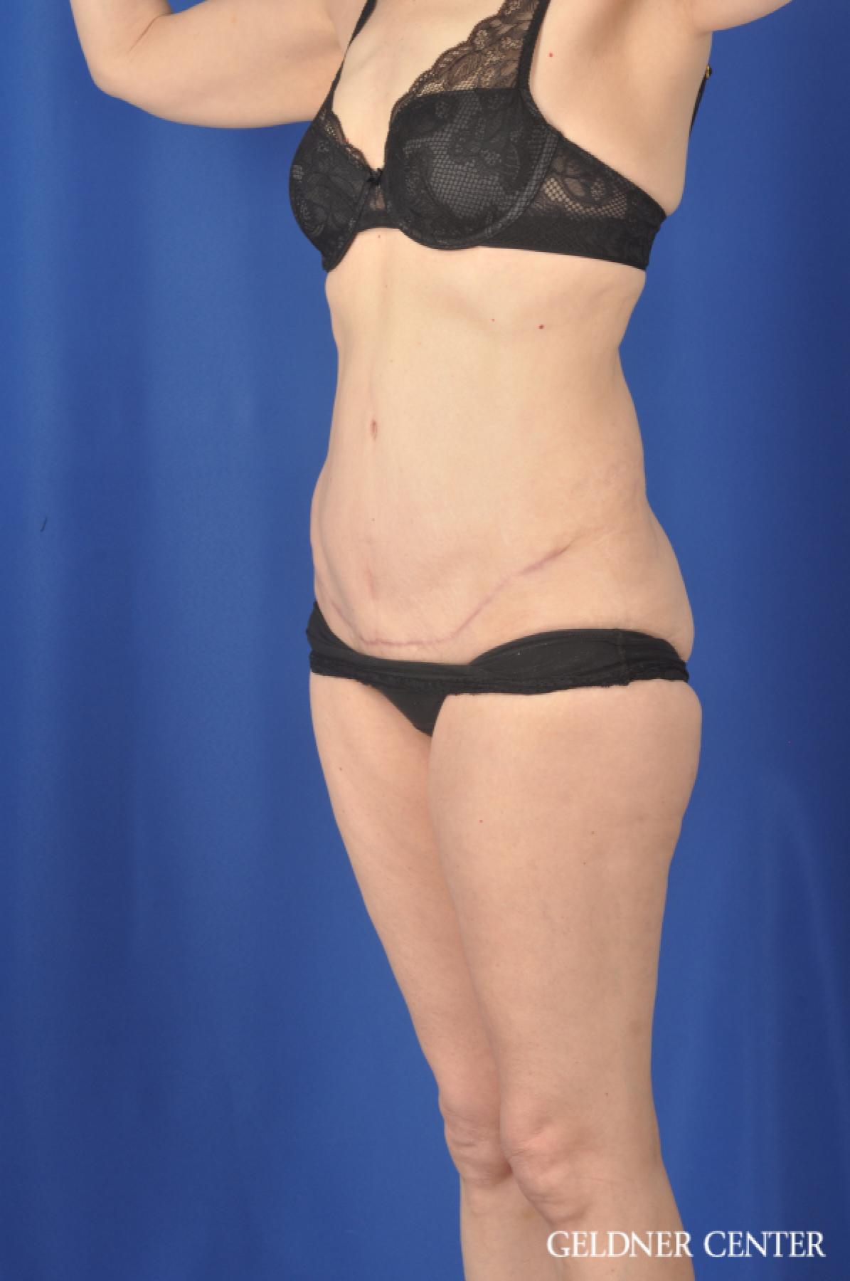 Liposuction: Patient 33 - After 5