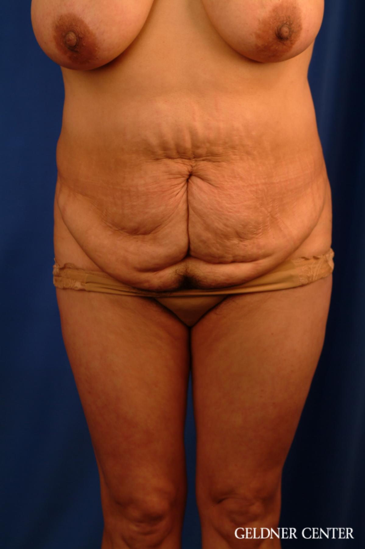 Tummy Tuck: Patient 16 - Before 1