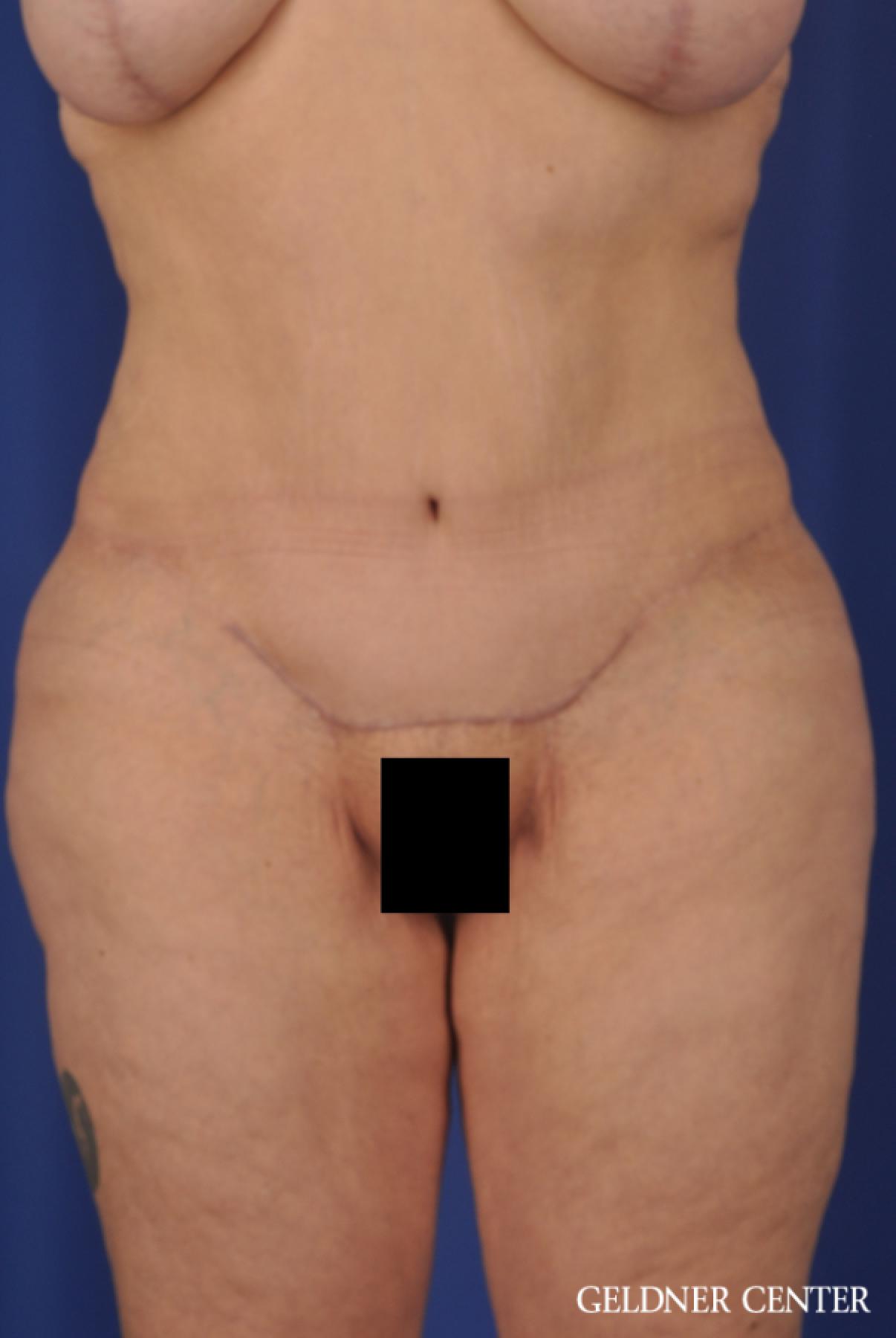 Tummy Tuck: Patient 19 - After 