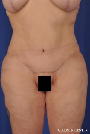 Tummy Tuck: Patient 19 - After 1