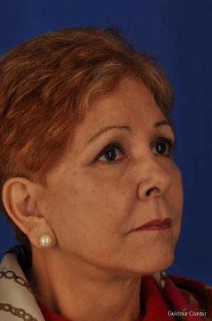Neck Lift: Patient 1 - After Image 3