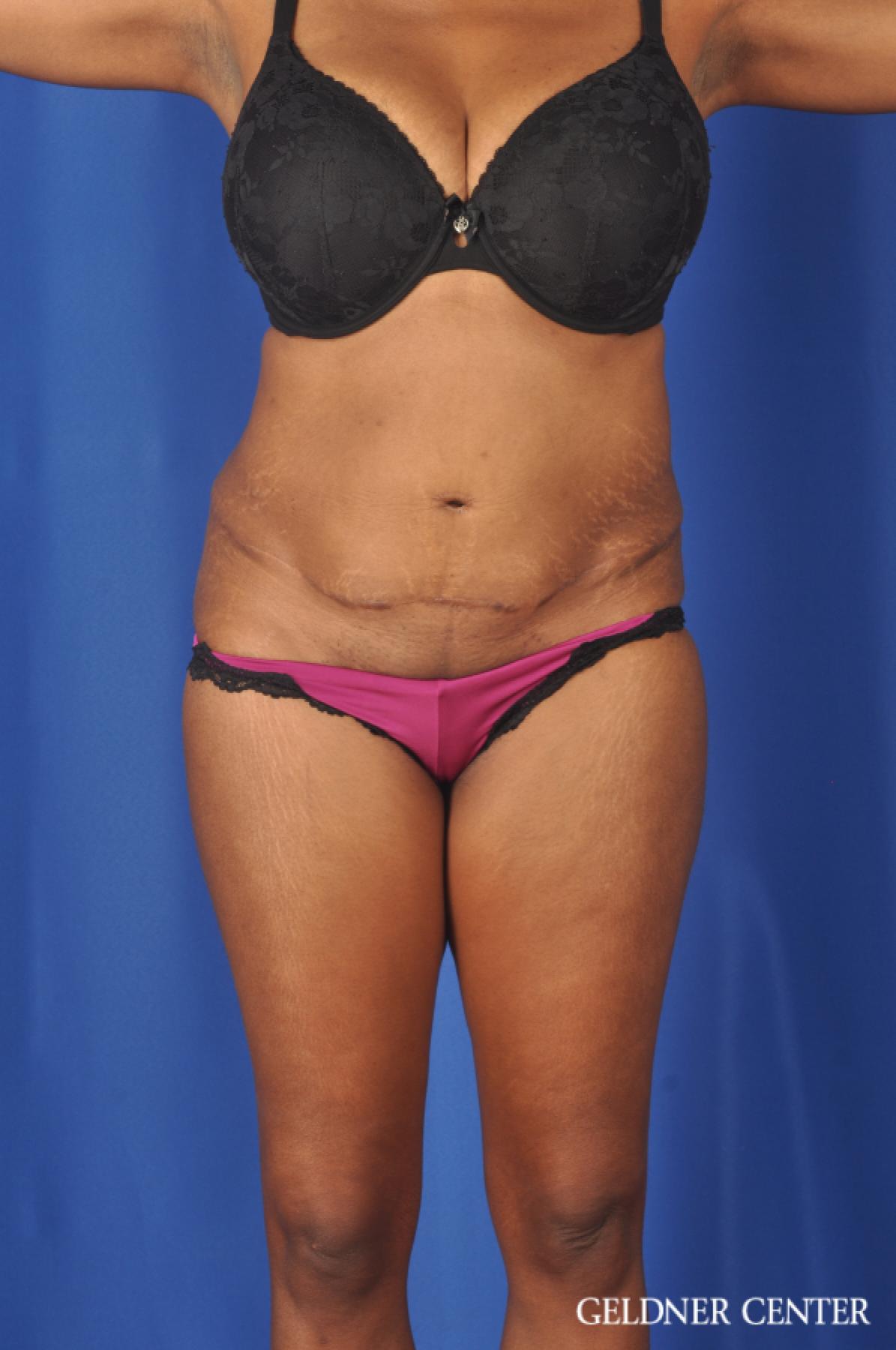 Liposuction: Patient 40 - Before 