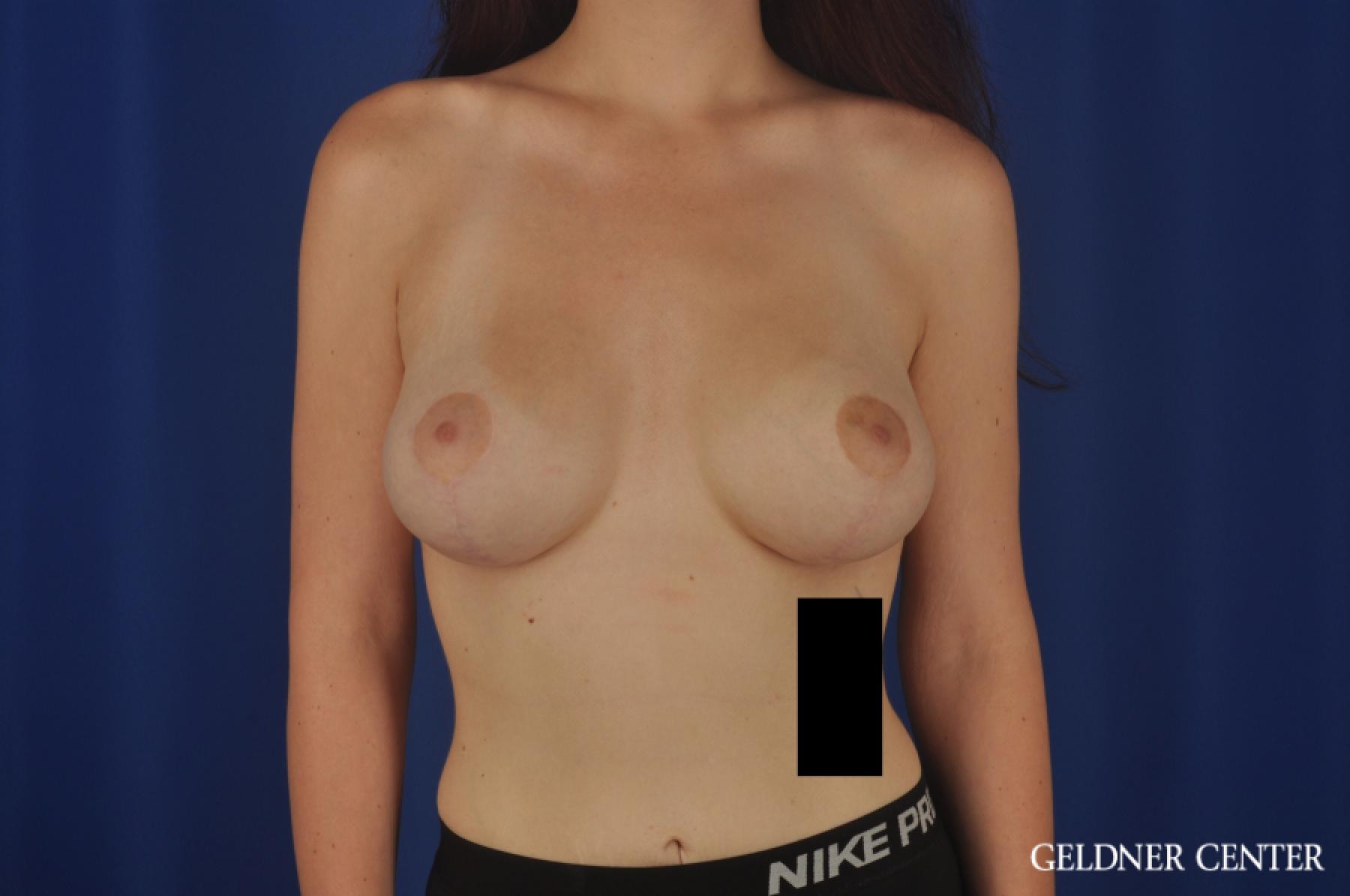 Breast Augmentation Streeterville, Chicago 5547 -  After 1