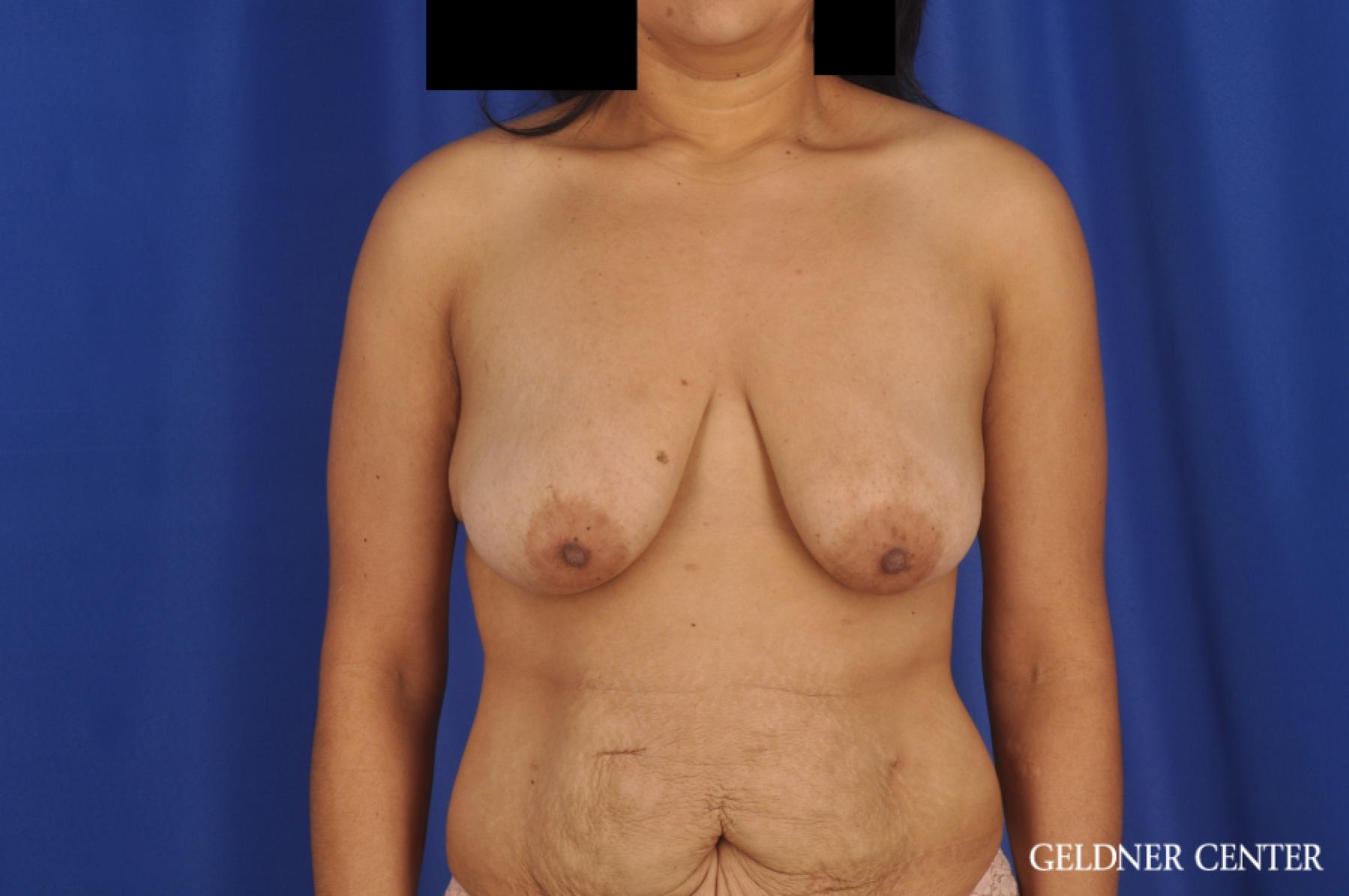 Breast Lift: Patient 49 - Before 1