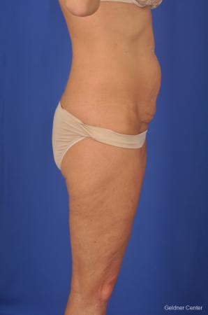 Lipoabdominoplasty: Patient 2 - Before Image 3