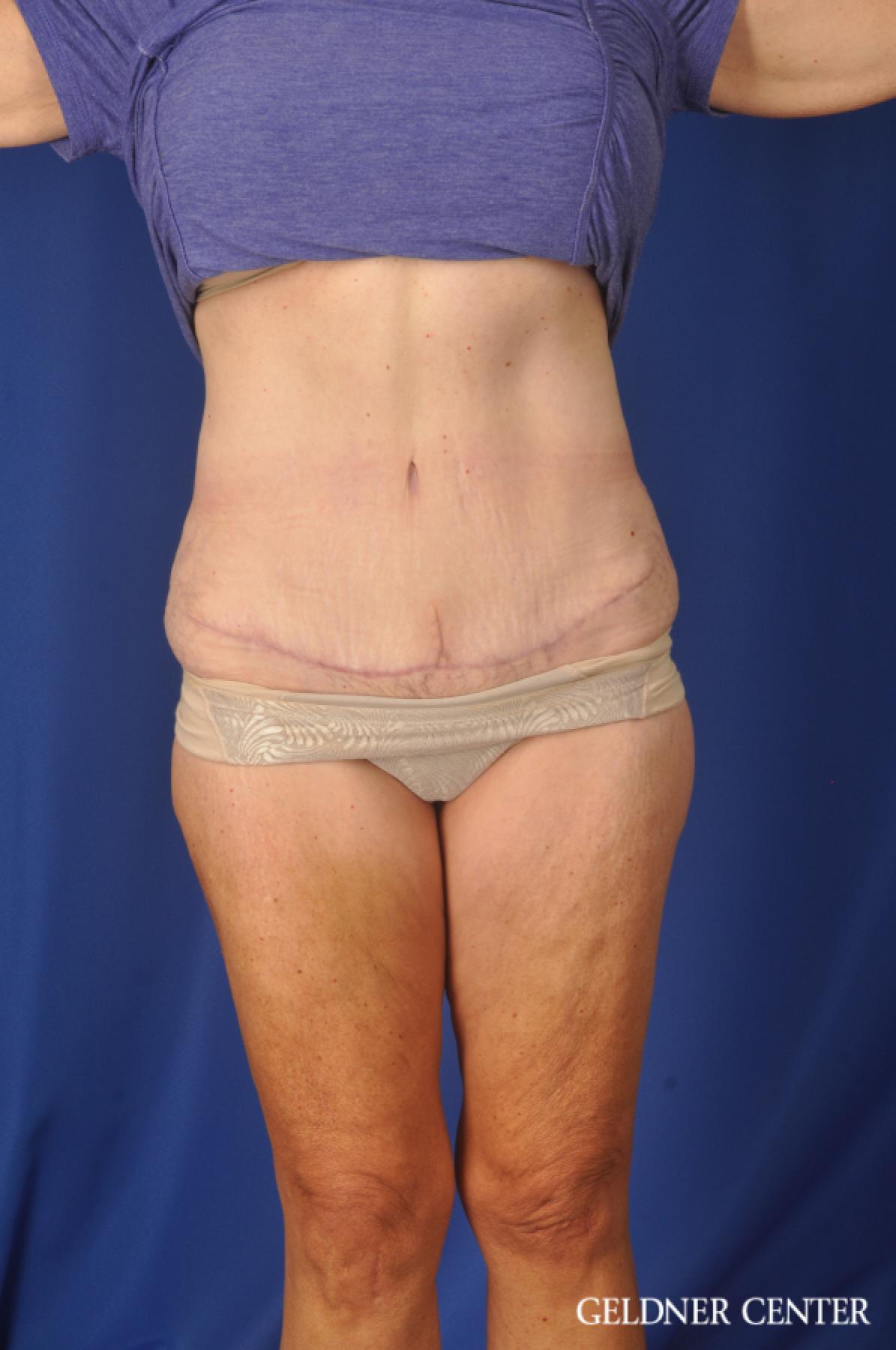 Abdominoplasty Lake Shore Dr, Chicago 11858 - After