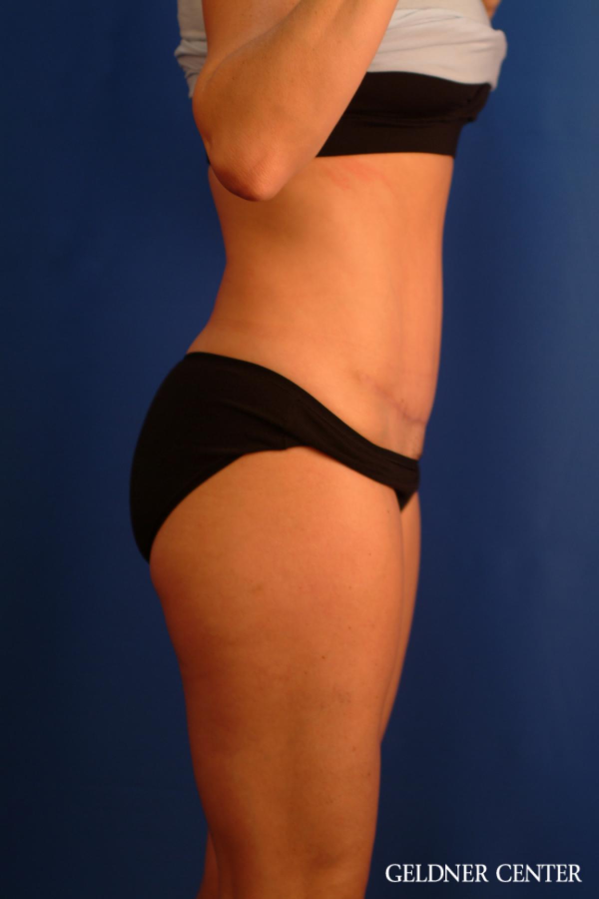 Tummy Tuck: Patient 34 - After 3