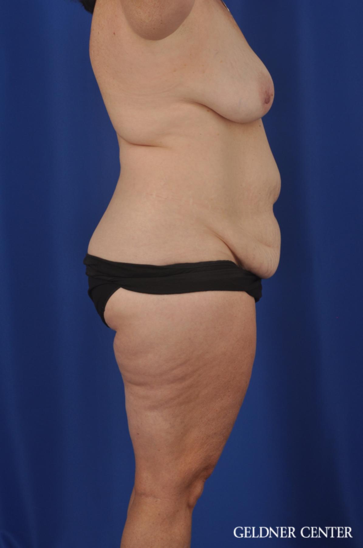 Abdominoplasty Patient 1 before and after photos - Before 3