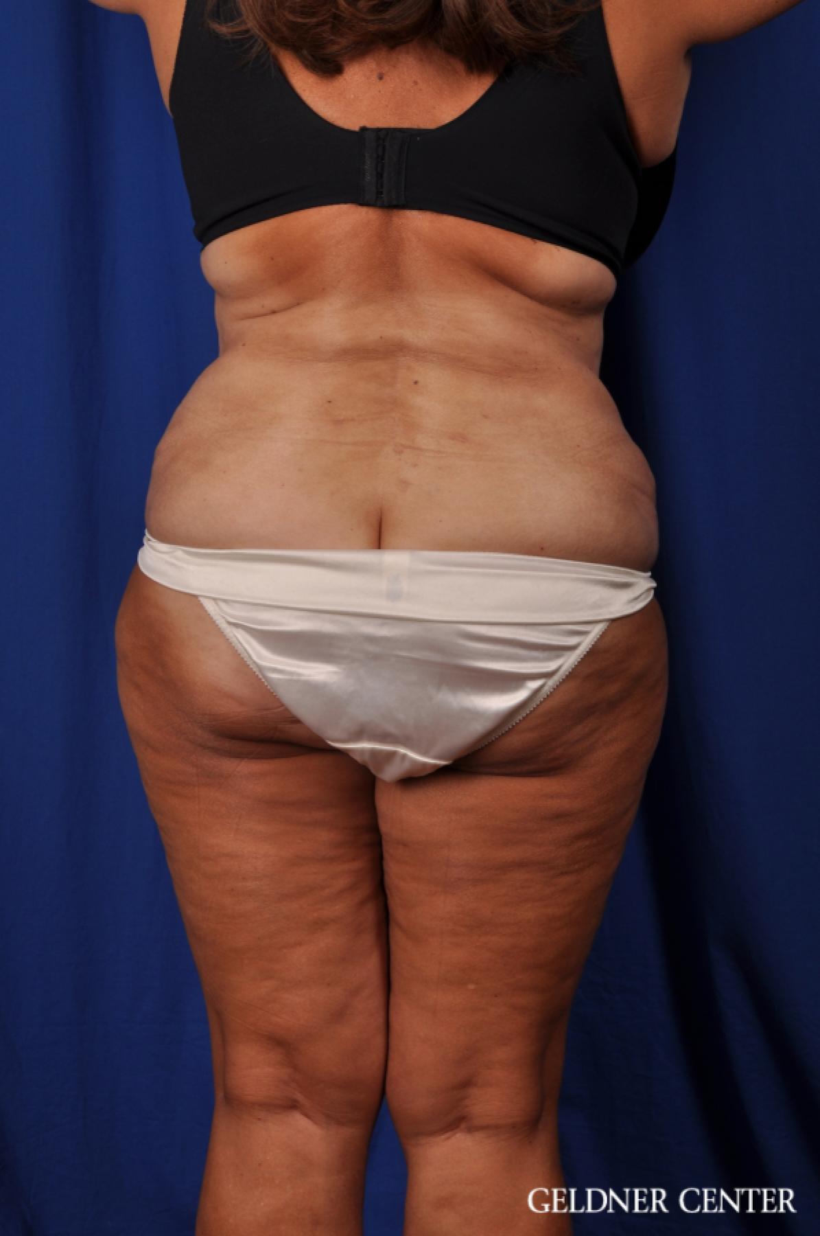 Tummy Tuck: Patient 20 - After 3