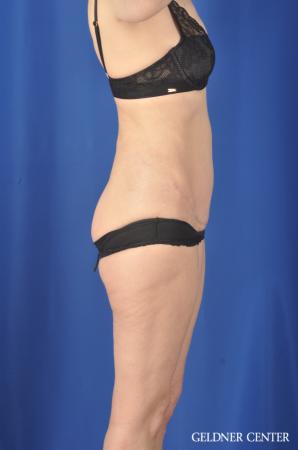 Chicago Abdominoplasty 11851 - After Image 3