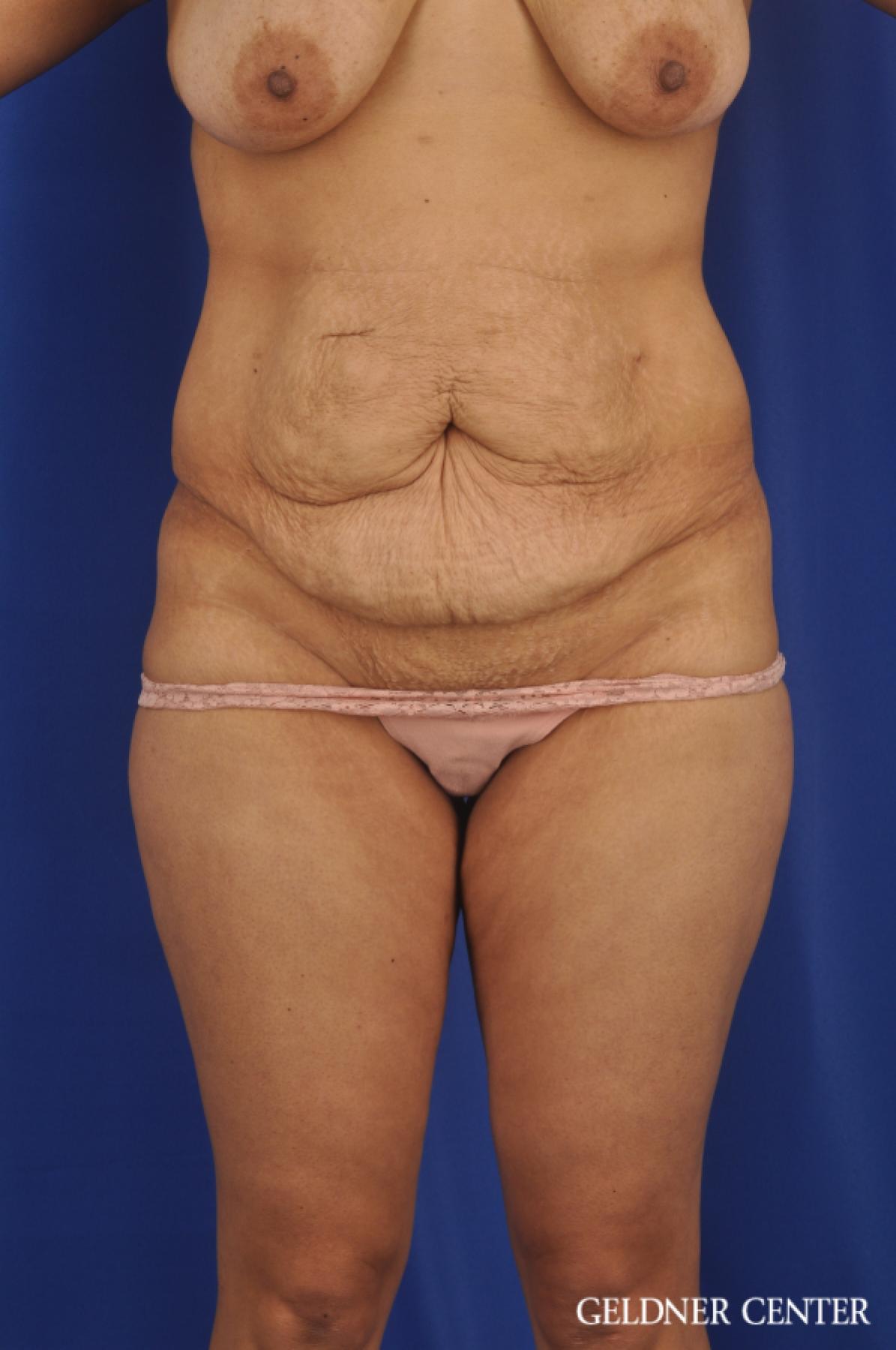 Tummy Tuck: Patient 33 - Before 