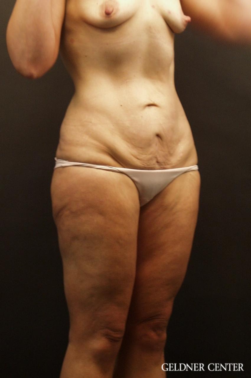 Tummy Tuck: Patient 17 - Before 3