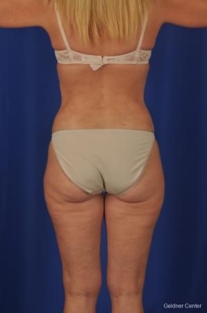 Lipoabdominoplasty: Patient 2 - After Image 4