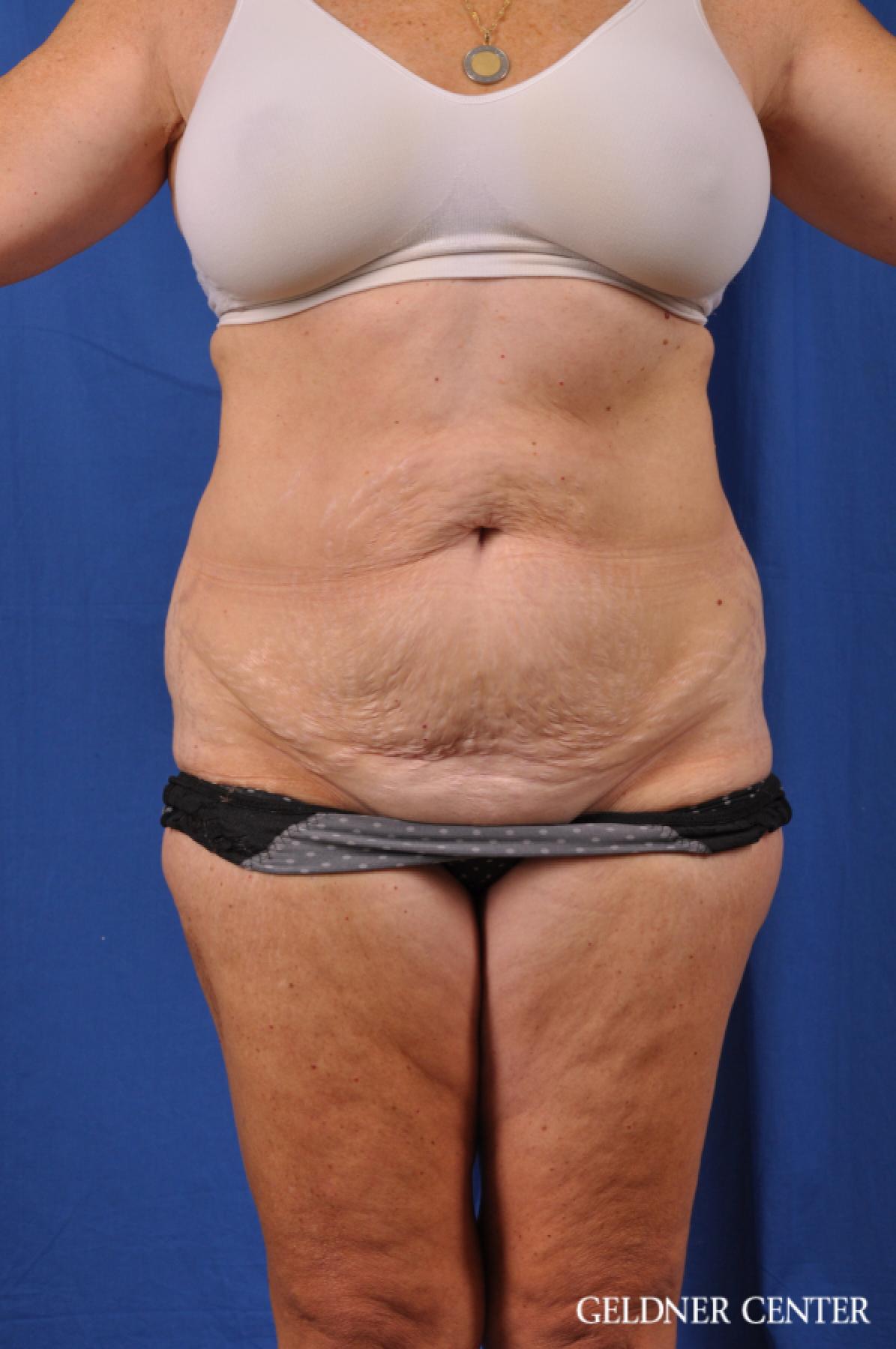 Abdominoplasty Lake Shore Dr, Chicago 11858 - Before