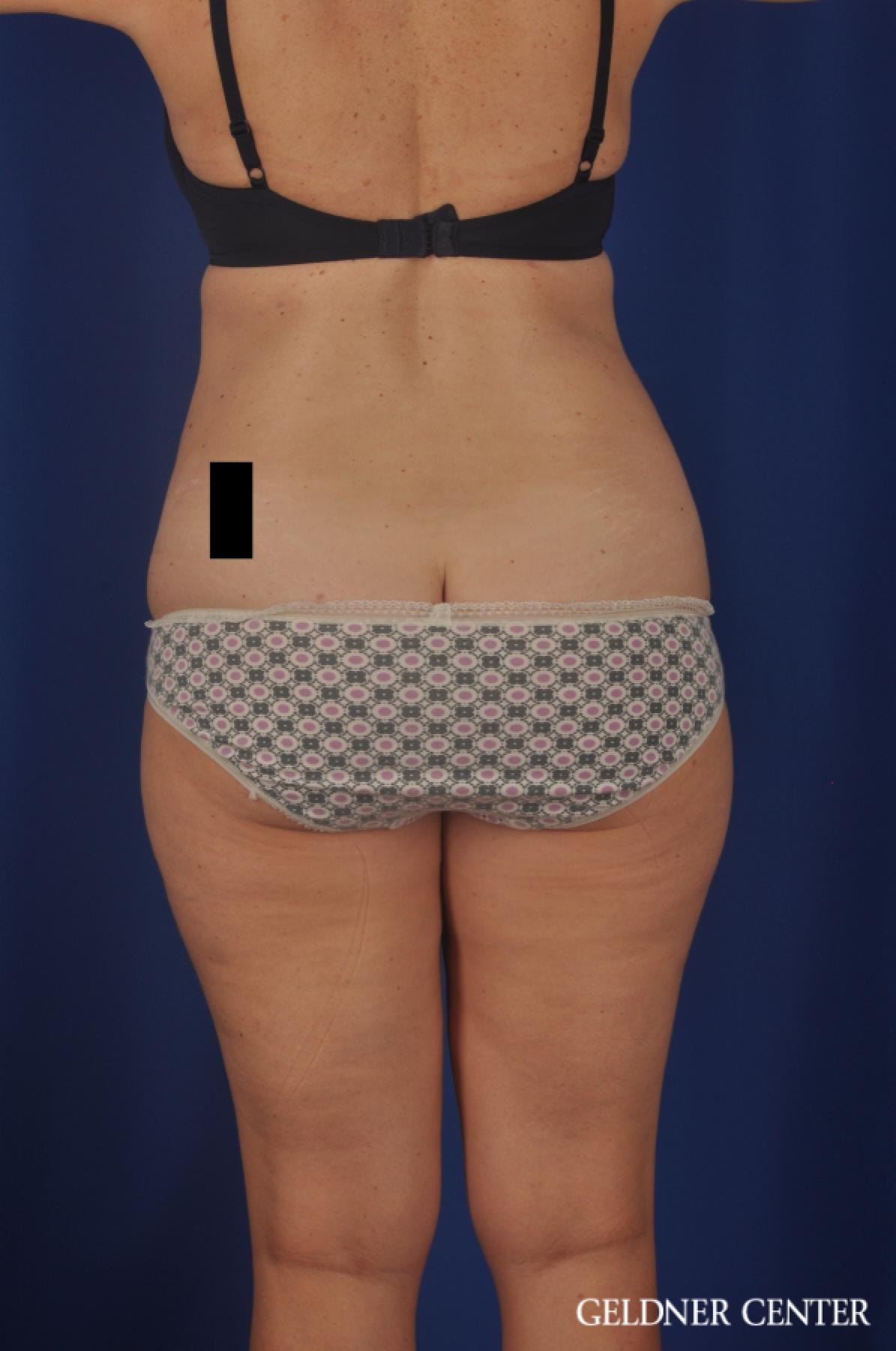 Tummy Tuck: Patient 22 - After 4