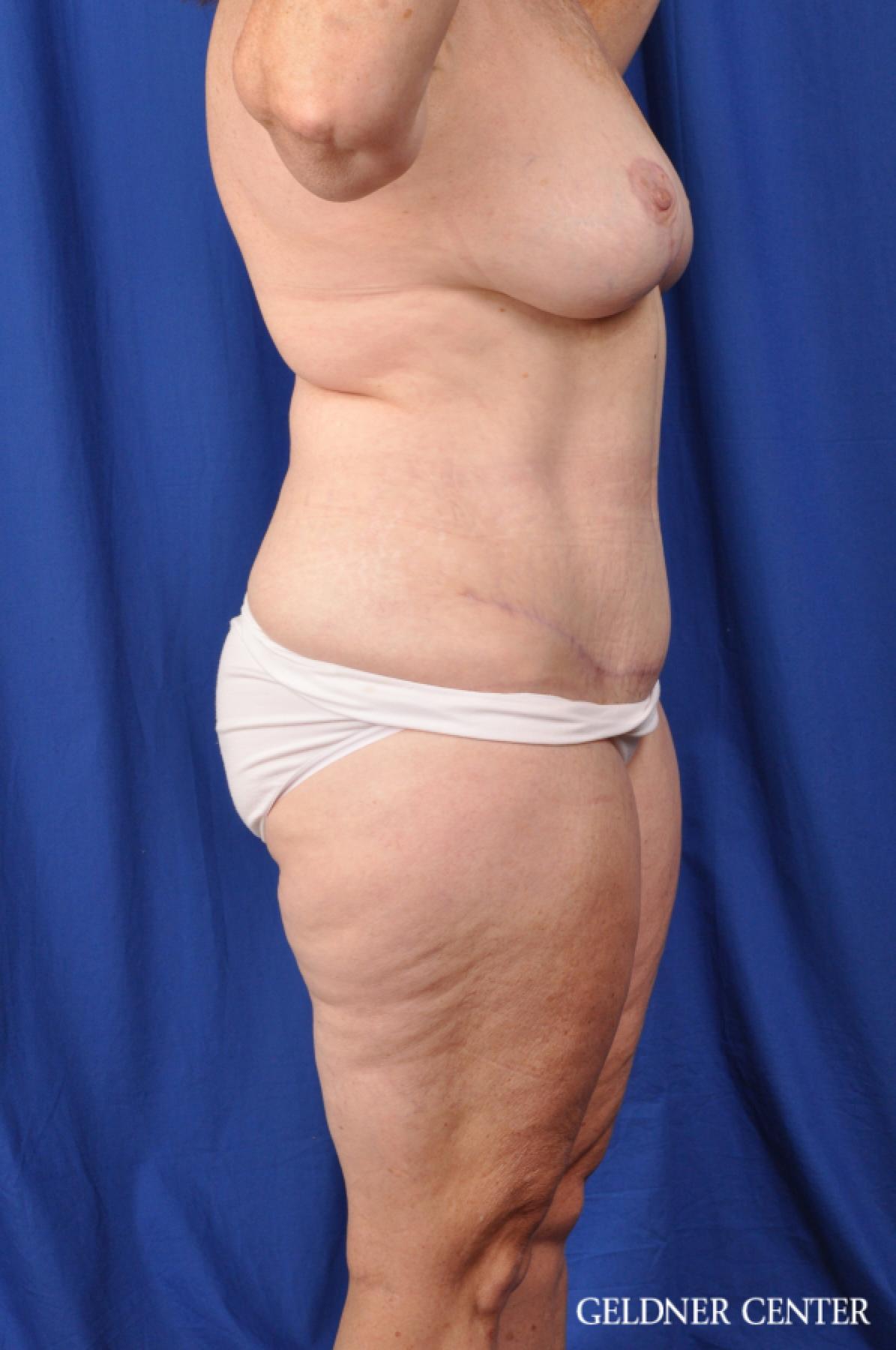 Abdominoplasty Patient 1 before and after photos -  After 3