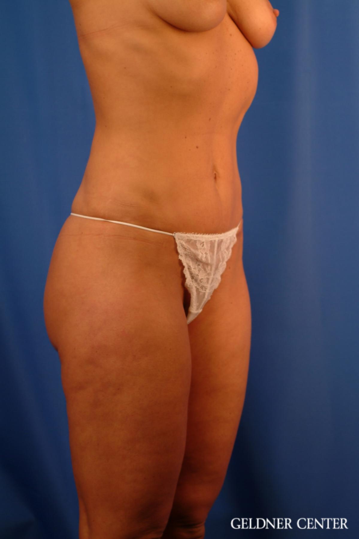 Tummy Tuck: Patient 15 - After 2