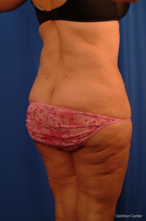 Lipoabdominoplasty: Patient 3 - After Image 3