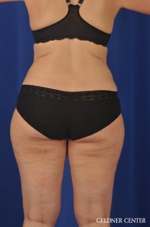 Liposuction: Patient 32 - Before 3