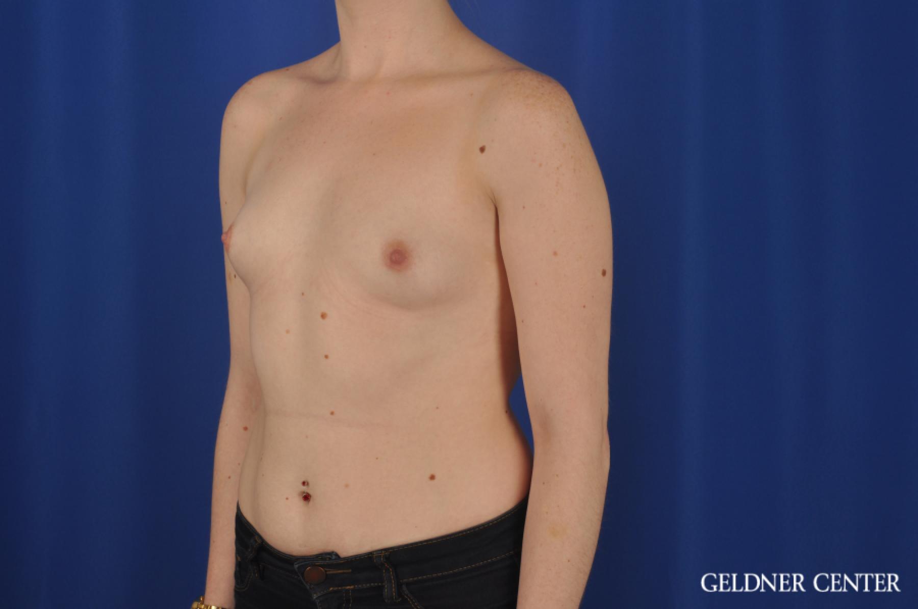 Breast Augmentation: Patient 138 - Before and After 4