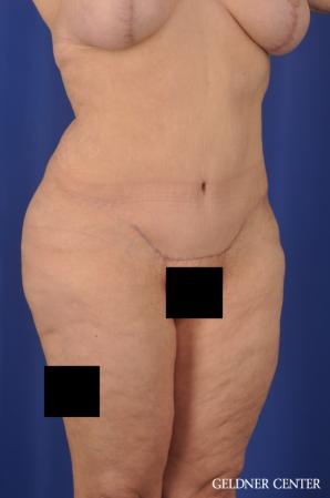 Liposuction: Patient 23 - After 2