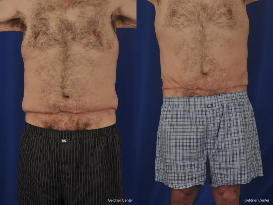 Abdominoplasty-for-men: Patient 3 - Before and After  