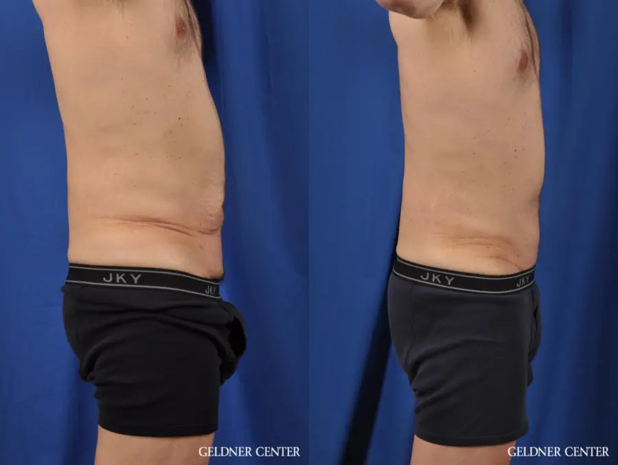 Abdominoplasty For Men: Patient 2 - Before and After 3