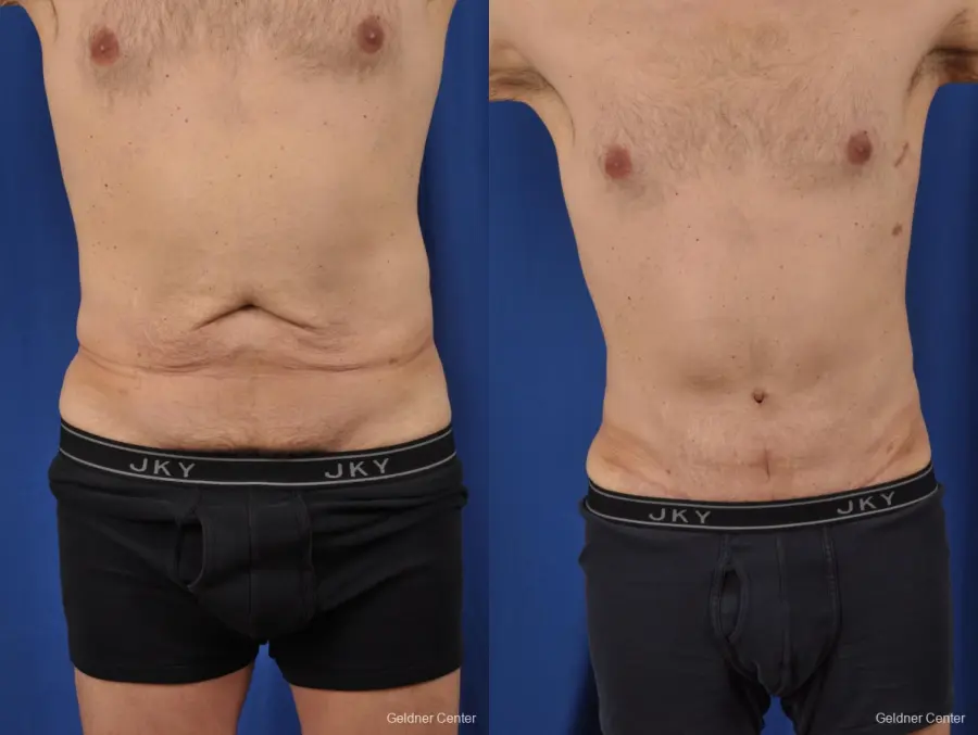 Abdominoplasty-for-men: Patient 2 - Before and After  