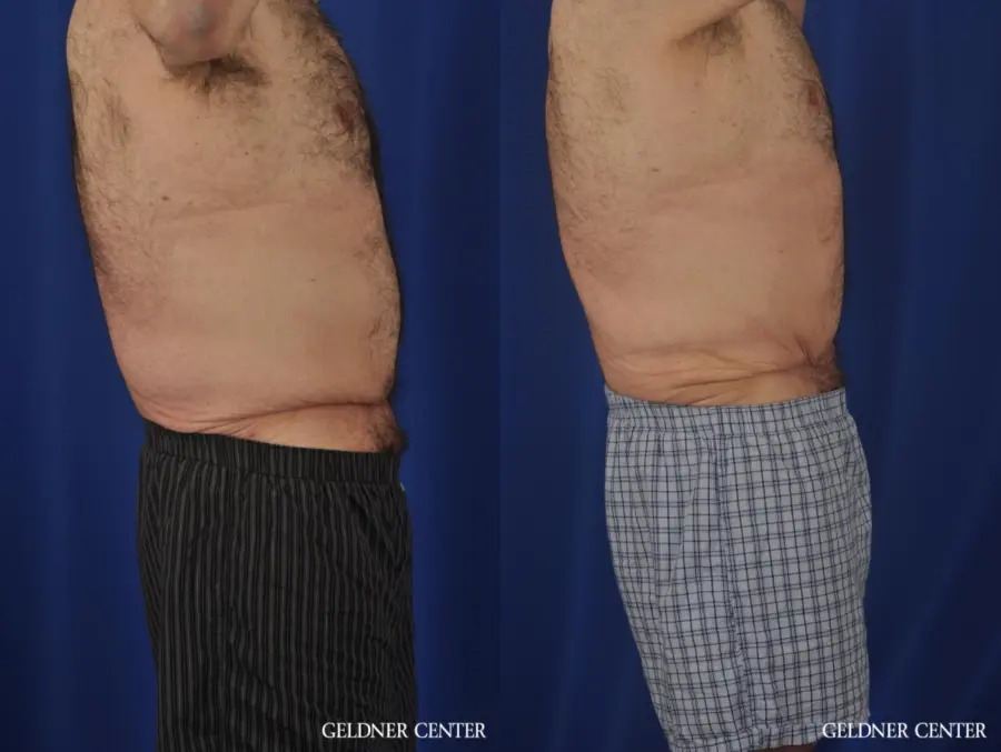 Abdominoplasty For Men: Patient 3 - Before and After 3