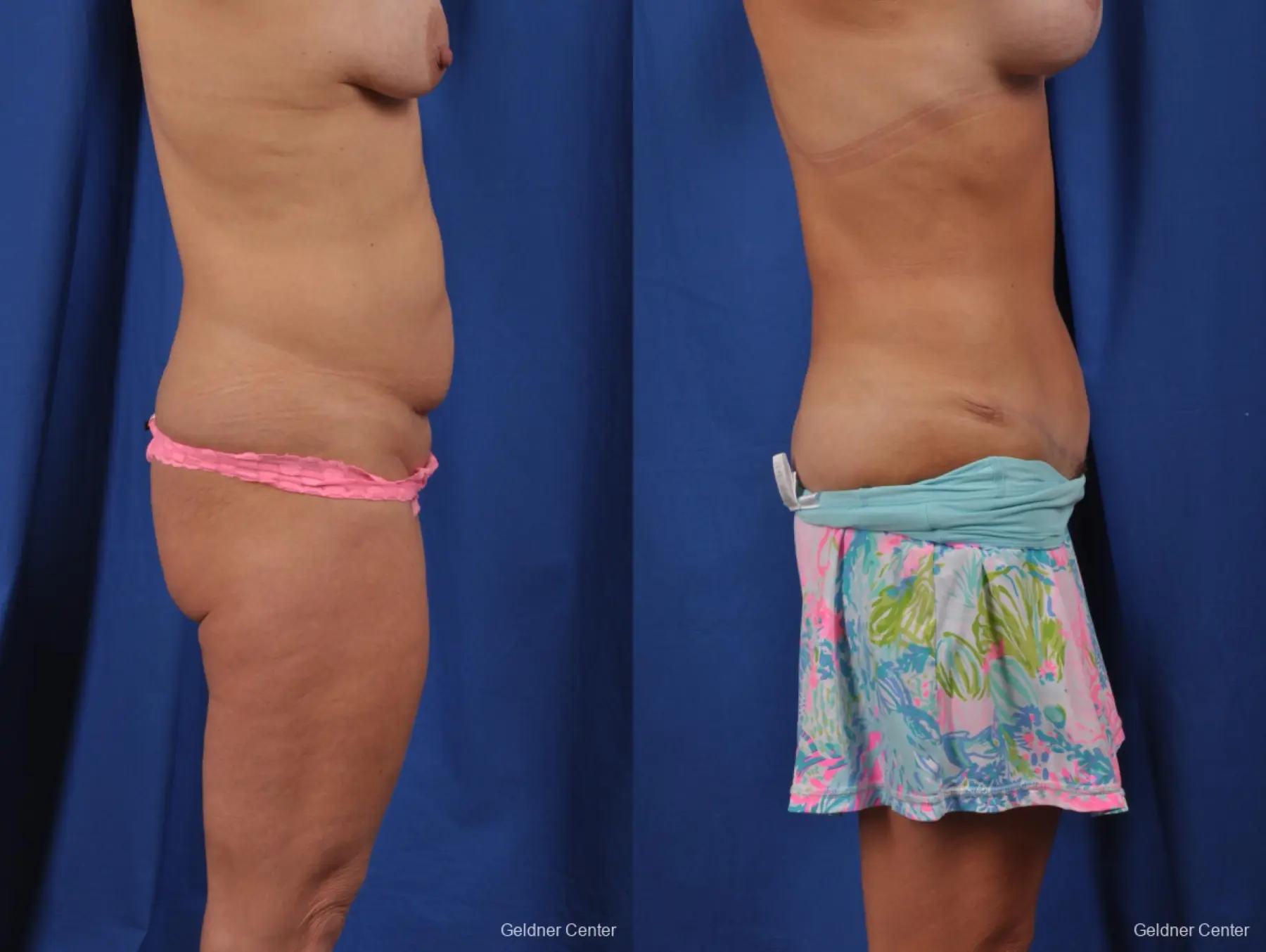 Abdominoplasty: Patient 1 - Before and After 2