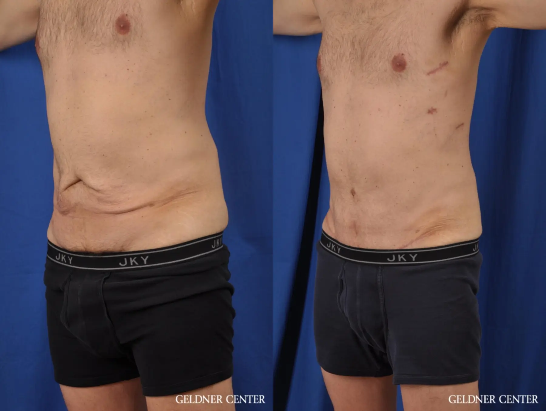 Abdominoplasty For Men: Patient 2 - Before and After 4