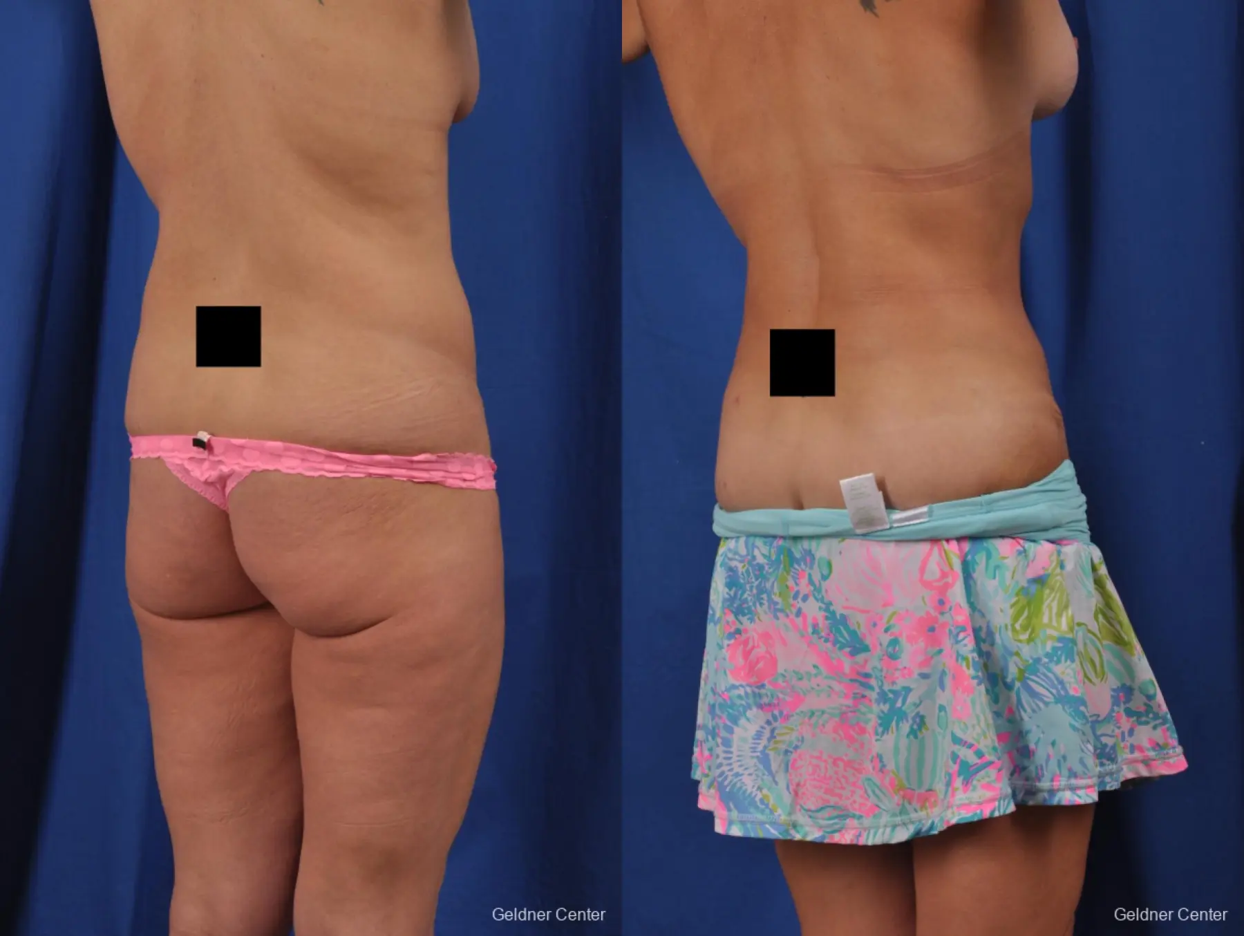 Abdominoplasty: Patient 1 - Before and After 5